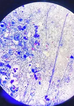 Mycobacterium pus sample. Microscopic view. Ziehl Neelsen stain. Stock Photos