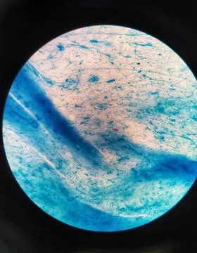 Mycobacterium sputum sample. Microscopic view. Ziehl Neelsen stain. TBC. Stock Photos