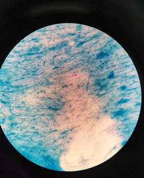 Mycobacterium sputum sample. Microscopic view. Ziehl Neelsen stain. TBC. Stock Photos