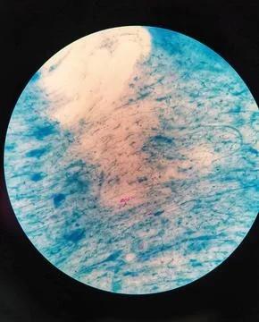 Mycobacterium sputum sample. Microscopic view. Ziehl Neelsen stain. TBC. Stock Photos