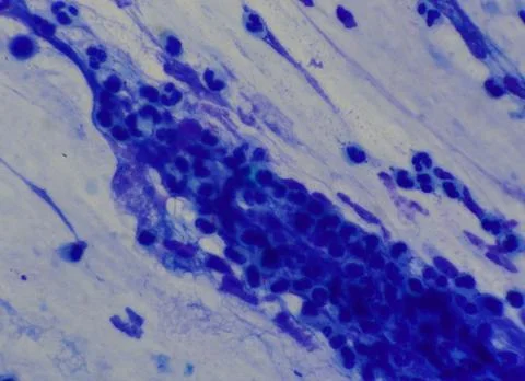 Mycobacterium tuberculosis appearance under the microscope is red with AFB .. Stock Photos