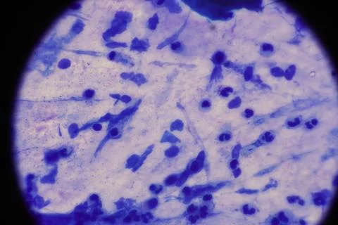 Mycobacterium tuberculosis appearance under the microscope is red with AFB .. Stock Photos