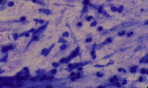 Mycobacterium tuberculosis appearance under the microscope is red with AFB .. Stock Photos