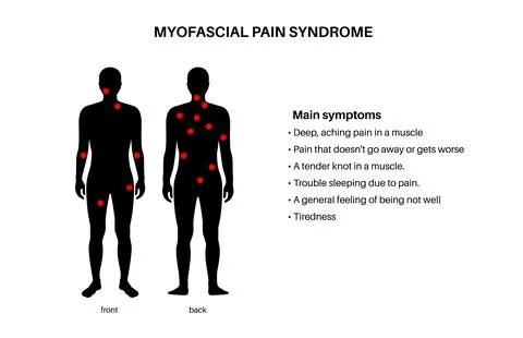 Myofascial trigger points Illustrazione stock