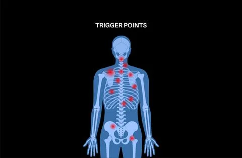 Myofascial trigger points Illustrazione stock