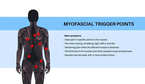 Myofascial trigger points Illustrazione stock