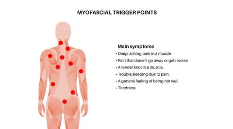 Myofascial trigger points Illustrazione stock