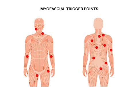 Myofascial trigger points Illustrazione stock