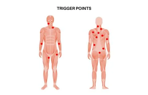 Myofascial trigger points Illustrazione stock