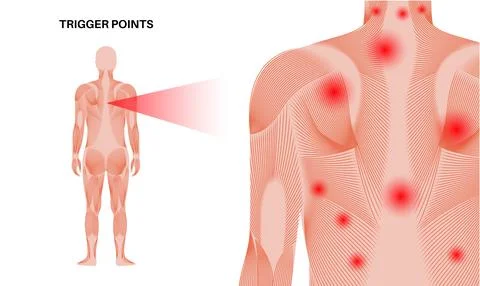 Myofascial trigger points Stock Illustration