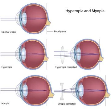 Myopia and hyperopia Stock Illustration