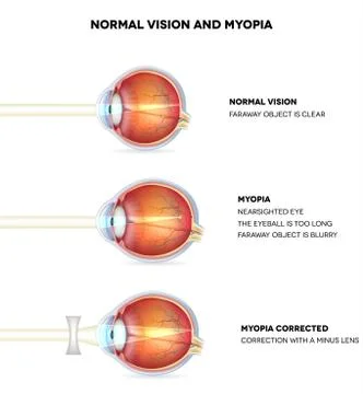 Myopia and normal vision Stock Illustration