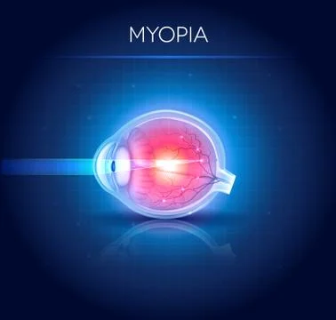 Myopia eyesight disorder Stock Illustration