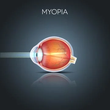 Myopia Stock Illustration