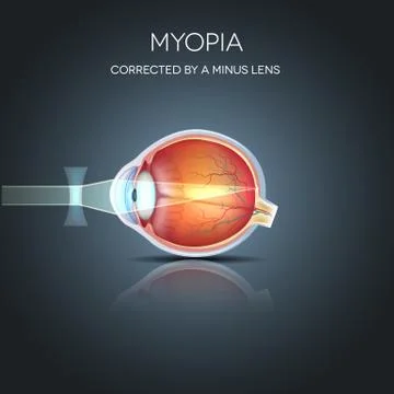 Myopia Stock Illustration