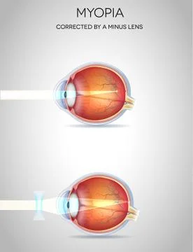 Myopia Stock Illustration