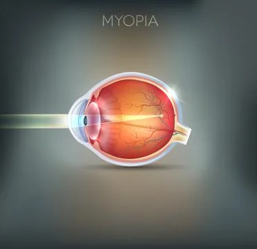 Myopia Stock Illustration