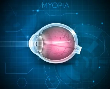 Myopia Stock Illustration