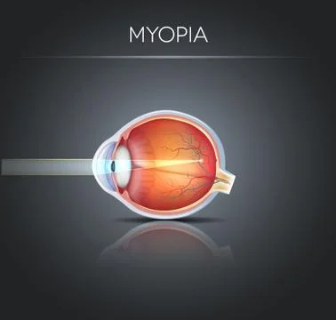 Myopia, vision disorder Stock Illustration