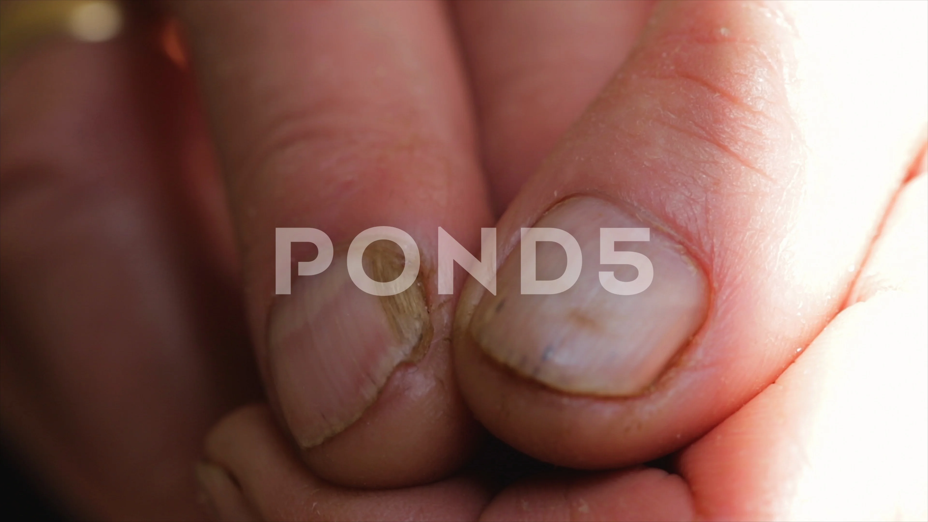 Pedicure Tutorial：bad nail fungus treatment【Pedicure Master Lin Jun】 -  YouTube