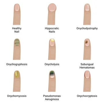 Nail diseases vector illustration design. Stock Illustration