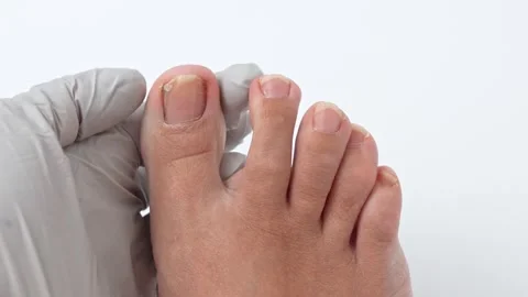 Nail psoriasis treatment process showing gradual removal of affected nail area Stock Footage 318494582