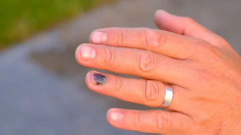 The nail turned black from the blow. Selective focus. Stock Footage 287831004