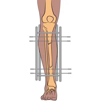 Nails in leg. Stock Illustration