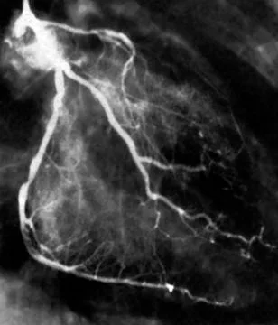 Narrowed coronary arteries, x-ray Stock Photos