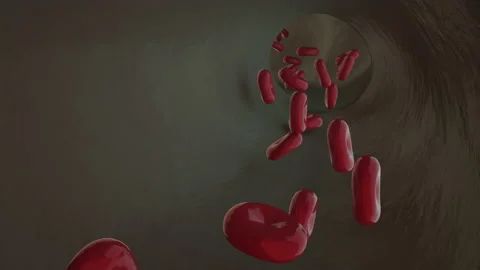 Narrowing of the arteries due to the formation of plaques on their walls. Hypert Stock Footage 168224331