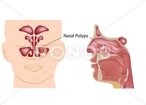 Nasal polyps Stock Illustration