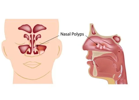 Nasal polyps Stock Illustration