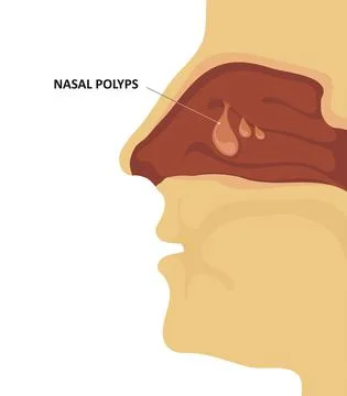Nasal polyps. Sinus congestion. Vector illustration Stock Illustration
