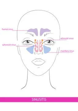 Nasal sinus. inflammation Stock Illustration