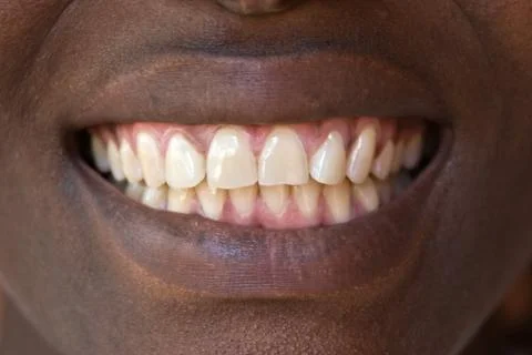Natural teeth Stock Photos