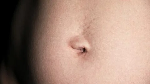 Navel close-up front view. A woman's stomach after pregnancy with stretch marks Stock Photos