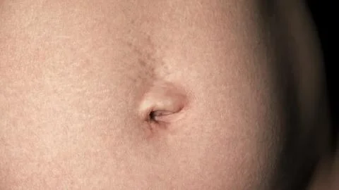 Navel close-up front view. A woman's stomach after pregnancy with stretch marks Stock Photos