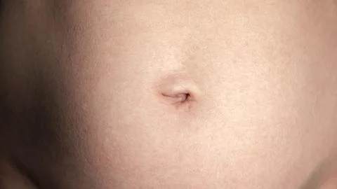Navel close-up front view. A woman's stomach after pregnancy with stretch marks Stock Photos