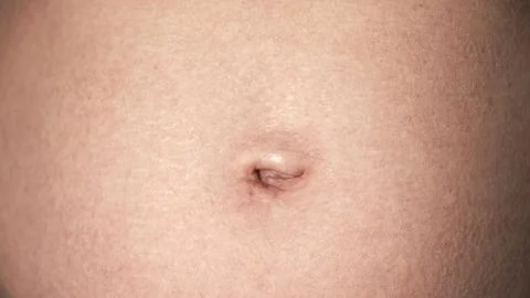 Navel close-up front view. A woman's stomach after pregnancy with stretch marks Stock Photos