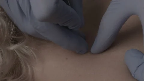 Neck acupuncture in a doctor's office Video stock 143160428