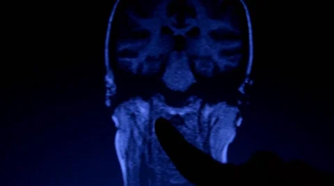 Neck and Head MRi Stock Footage 43910080