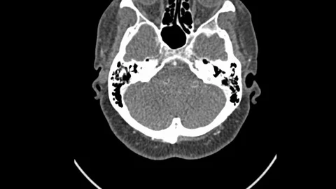Neck ct scan Stock Footage 81631323