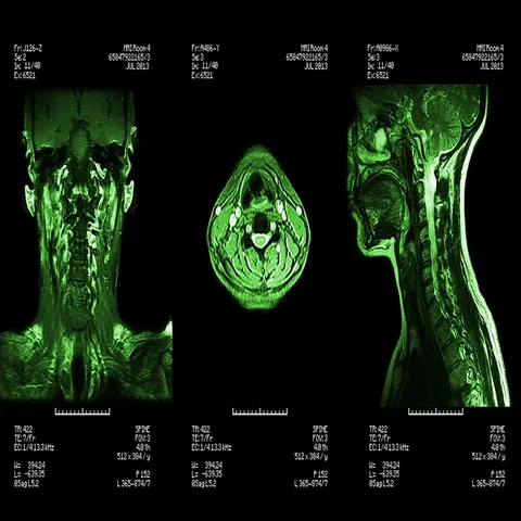 Neck MRI scan. Loopable. 스톡 동영상 69601550
