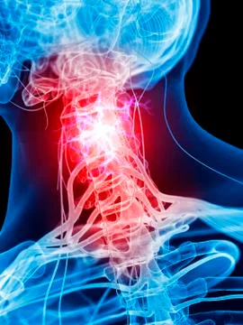 Neck nerve pain Stock Illustration