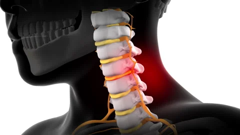 Neck pain can be caused by cervical disc herniation, 3d illustration Stock Footage 263330739