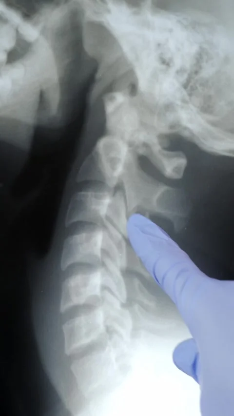 Neck spinal column with x-ray..Glove hand Видео 337033445