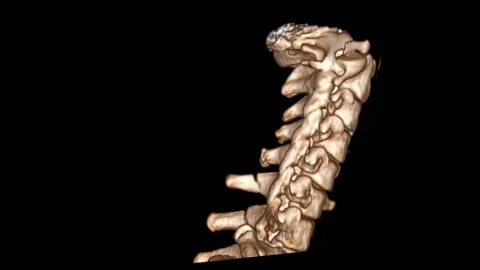 Neck vertebra dislocation, 3D CT scan Stock Footage 178666494