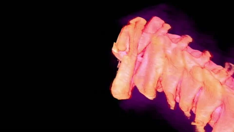 Neck vertebra dislocation, 3D CT scan Stock Footage 178666990