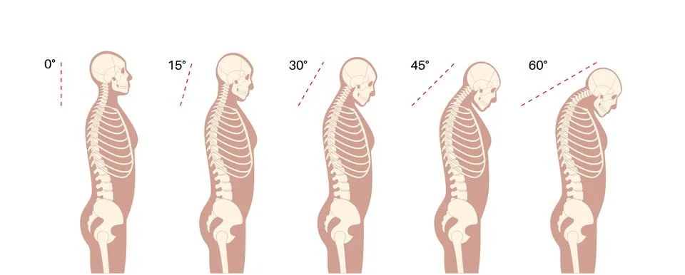 Neck vertebrae deformity Stock Illustration