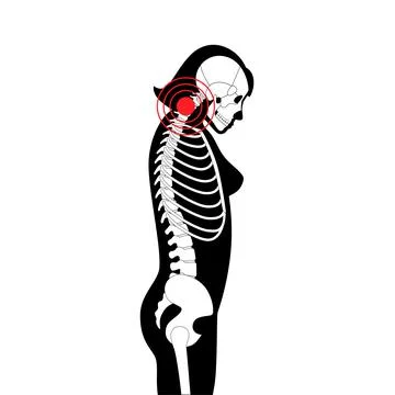 Neck vertebrae deformity Illustrazione stock